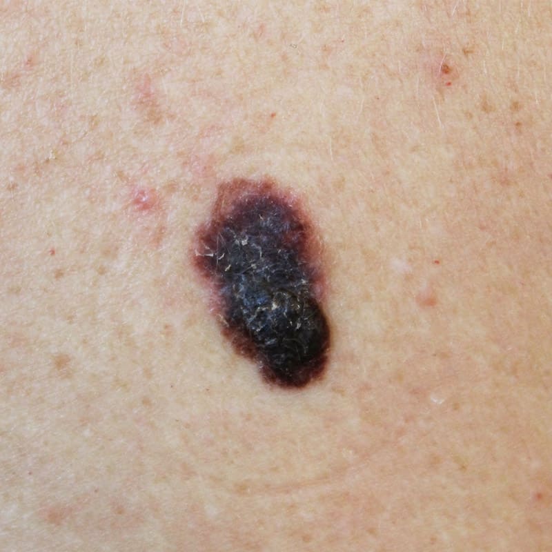 Skin Cancer - Skin & Medical Northbridge