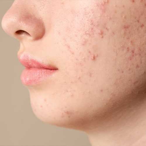 acne acne
