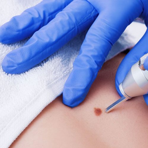 lesions lesions