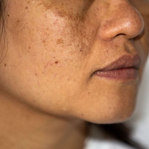 pigmentation pigmentation