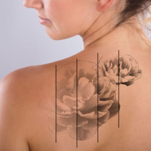 tattoo-removal tattoo-removal